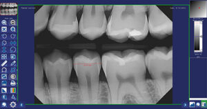 Measuring tool inside of DentiView imaging software