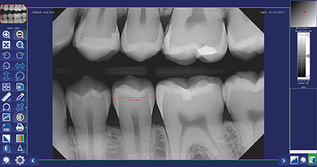 Measuring tool inside of DentiView imaging software