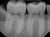 Dexis Sensor X-ray