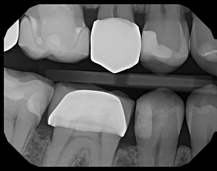 DentiMax Pro Sensor Exposure Comparison