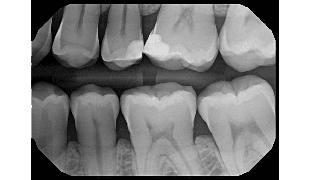 Left Bitewing X-Ray — DentiMax Pro Sensor