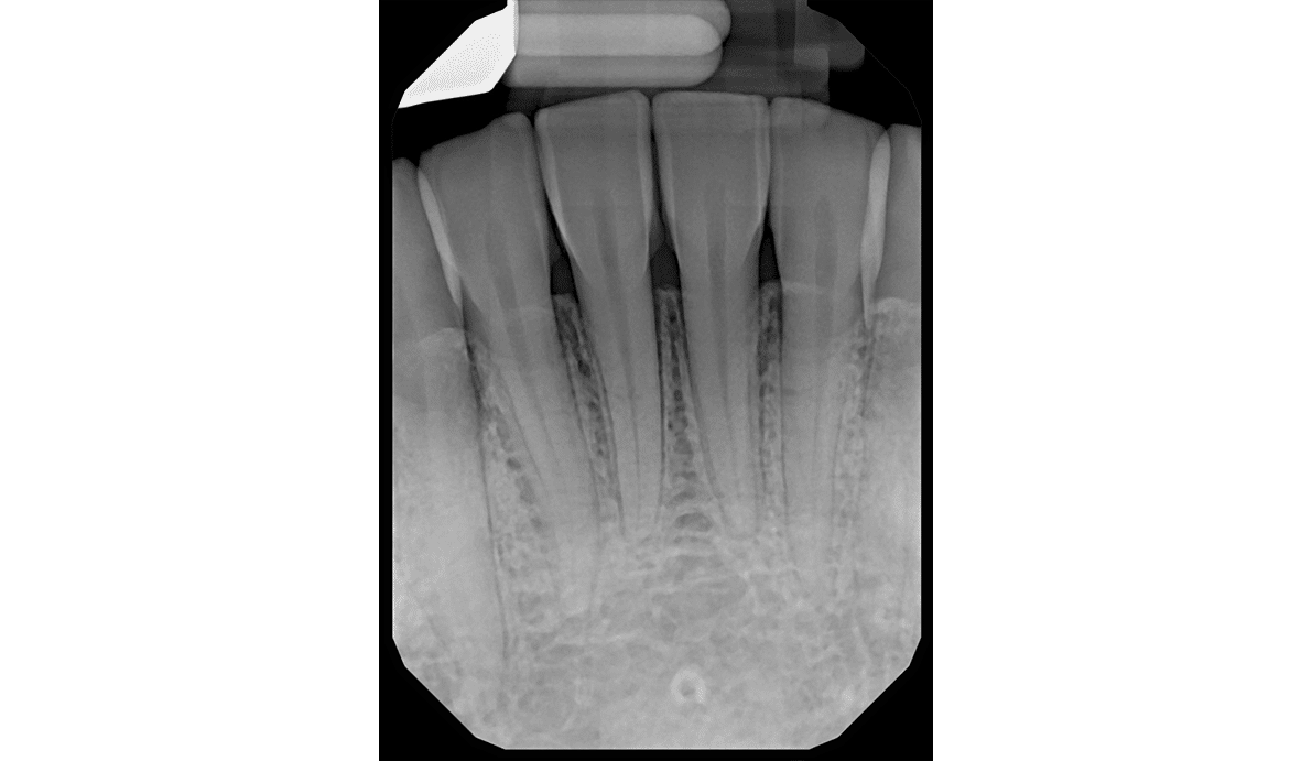 Mandibular Anterior X-Ray — DentiMax Pro Sensor