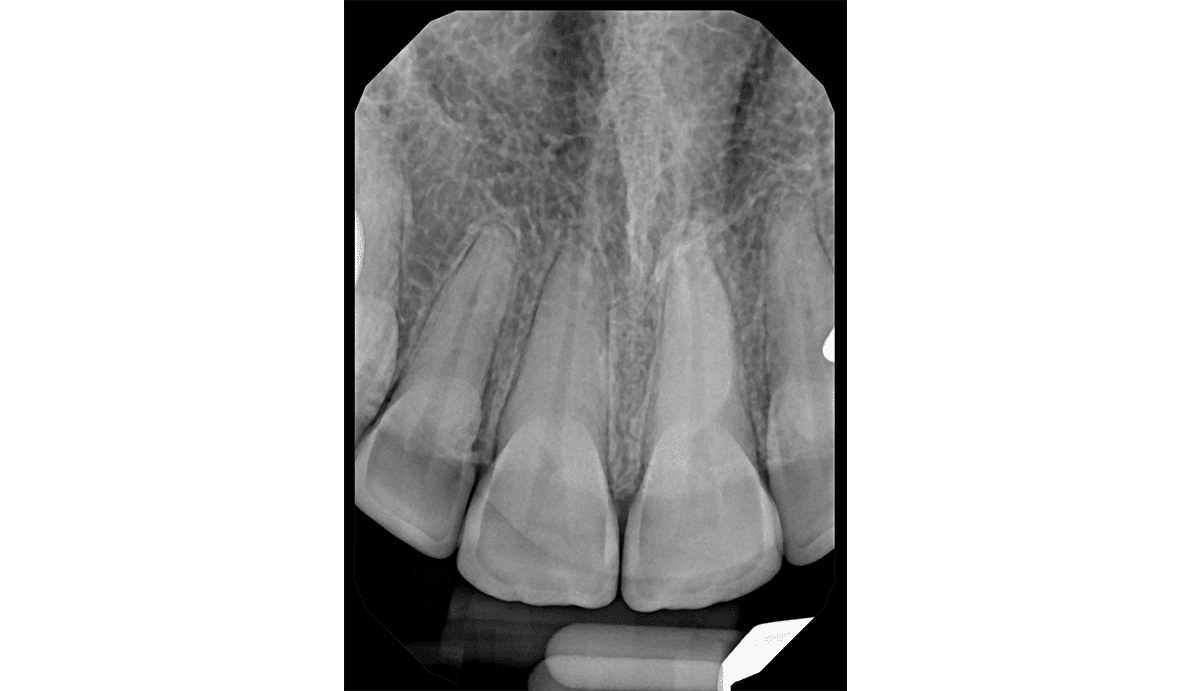 Maxillary Anterior X-Ray — DentiMax Pro Sensor