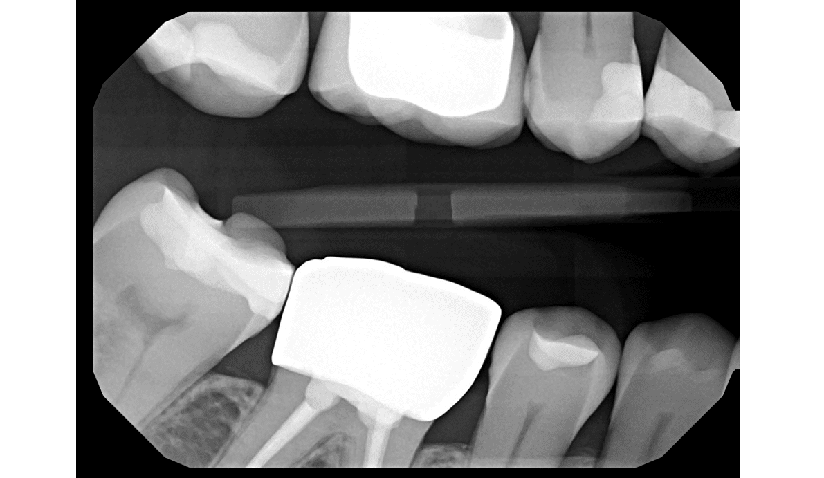 Right Bitewing X-Ray — DentiMax Pro Sensor